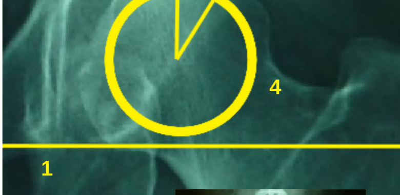 Εικόνα 1:  (1): η γραμμή που δημιουργείται από τα δύο σημεία του δακρύου (tear drop) και ορίζει τον εγκάρσιο άξονα του ασθενή, (2): η γραμμή που ξεκινά από το κέντρο της μηριαίας κεφαλής και ορίζει τον οβελιαίο άξονα, (3): η γραμμή που ξεκινά από το κέντρο της μηριαίας κεφαλής και καταλήγει το έξω σημείο της οροφής της κοτύλης, (4): ο κύκλος που το κέντρο του αντιστοιχεί το κέντρο της μηριαίας κεφαλής.
